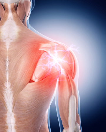 Shoulder Pain and Common Shoulder Problems - OrthoInfo - AAOS