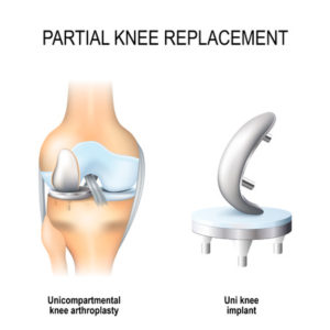 makoplasty total knee replacement